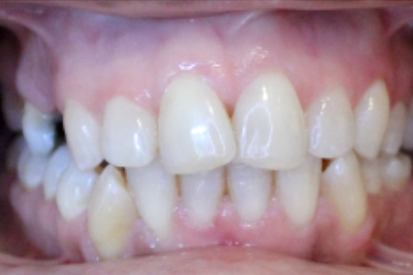 Smile Gallery - KD Orthodontics - Chandler AZ